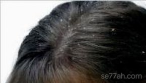 علاج تساقط الشعر قشرة الرأس