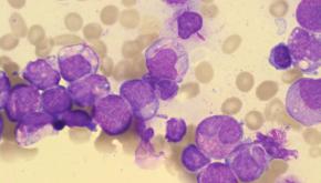 أهم أعراض سرطان الدم اللوكيميا وما هي أسبابه ؟